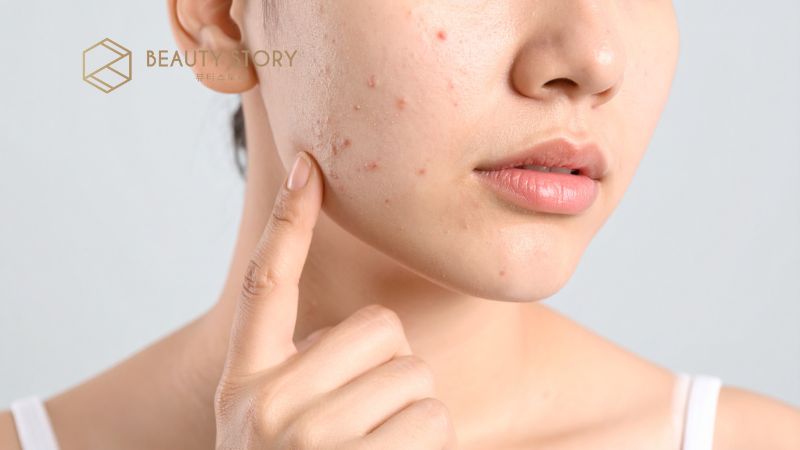 Cách trị thâm mụn cho da dầu nhạy cảm hiệu quả nhất